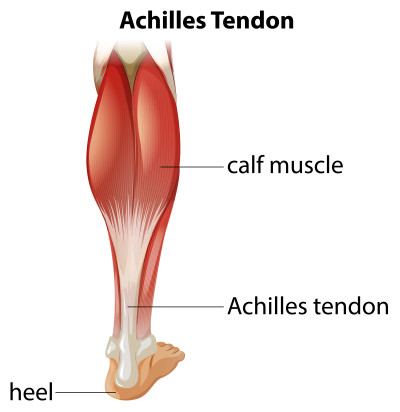Een achillespeesruptuur, ook bekend als een gescheurde achillespees, verwijst naar de situatie waarbij de achillespees, die zich aan de achterkant van het onderbeen bevindt, geheel of gedeeltelijk scheurt