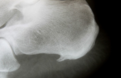 Diagnose stellen van hielpijn of hielspoor (Fasciitis plantaris).