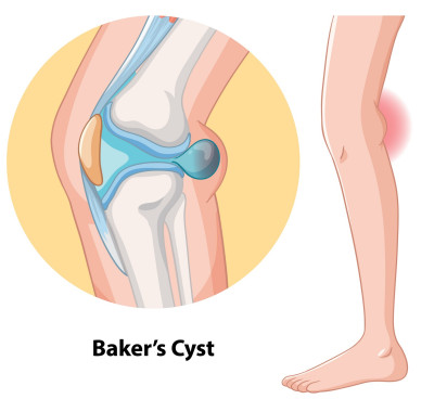 Een bakerse cyste, ook wel een popliteale cyste genoemd, is een goedaardige zwelling die zich vormt aan de achterkant van de knie.