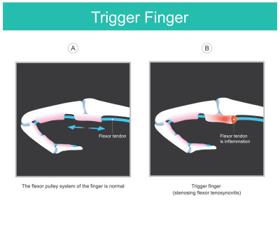 Een triggerfinger, ook wel bekend als 'hokkende vinger' of 'trekkerduim', is een aandoening die wordt gekenmerkt door het onvermogen om een vinger soepel te bewegen. 