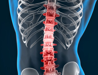 Ziekte van Scheuermann