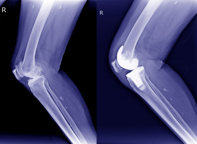 Röntgenfoto van een knie met Osgood-Schlatter