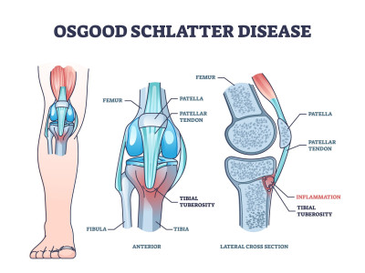 Osgood-Schlatter pijn in en rondom de knie. Anatomie van de knie.