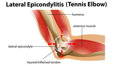 Tenniselleboog de anatomie