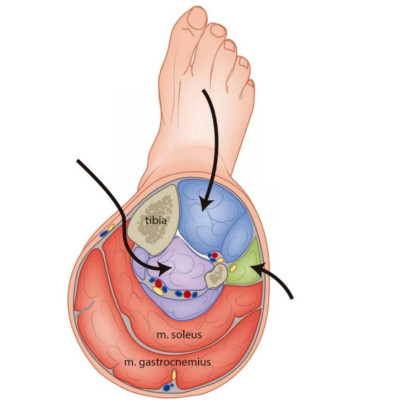 Doorsnede van het onderbeen, compartimentsyndroom.