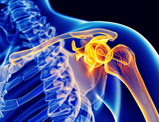 Het Thoracic Outlet Syndroom (TOS)