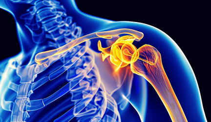 Het Thoracic Outlet Syndroom (TOS)