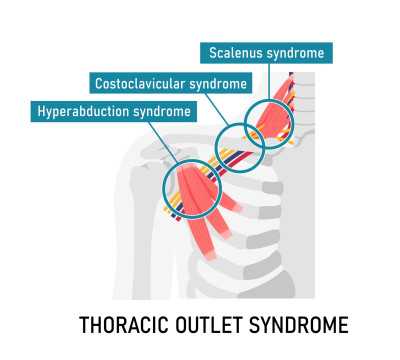 Thoracic Outlet Syndroom (TOS) Anatomie