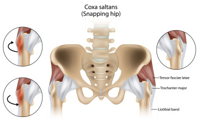 Snapping Hip bij het iliopsoas syndroom.