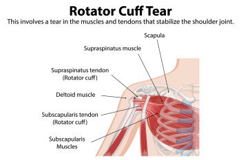 Anatomie van Rotator Cuff Letsel.