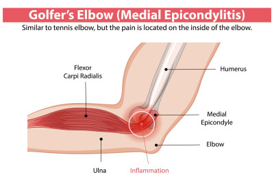Golfarm of Golferselleboog. Wat is het? Waar doet het pijn? Anatomie.