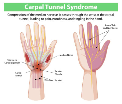 Carpaal Tunnel Syndroom Anatomie.