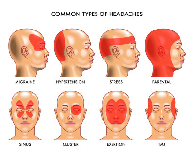 Er zijn verschillende vormen van spanningshoofdpijn