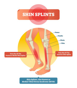 Shin splints is een veelvoorkomende aandoening waarbij de spieren, pezen en het bot in het voorste deel van het onderbeen pijn veroorzaken