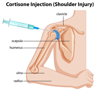 Behandeling van nek- en schouderklachten: corticosteroïden-injecties.